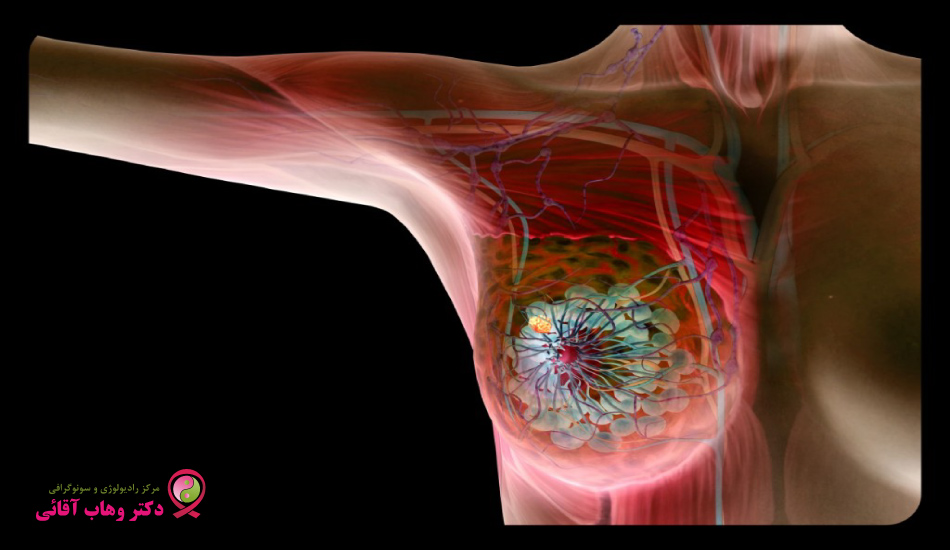 فیبروکیستیک پستان