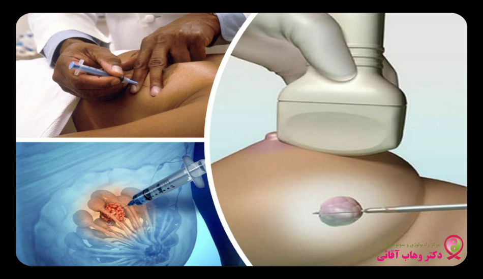 تشخیص فیبروکیستیک