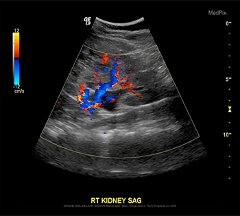 سونوگرافی کلیهه