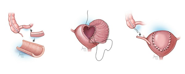 تغییر شکل مثانه
