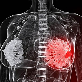 بیماری زوسکا