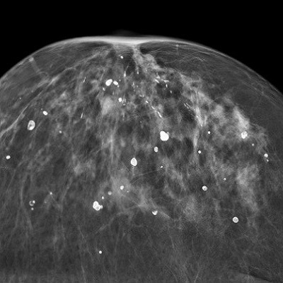 کلسیفیکاسیون پستان