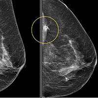میزان اشعه در ماموگرافی