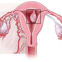 اختلالات رحم