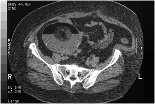 کیست در موئید تخمدان
