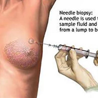 بیوپسی تحت گاید سونوگرافی