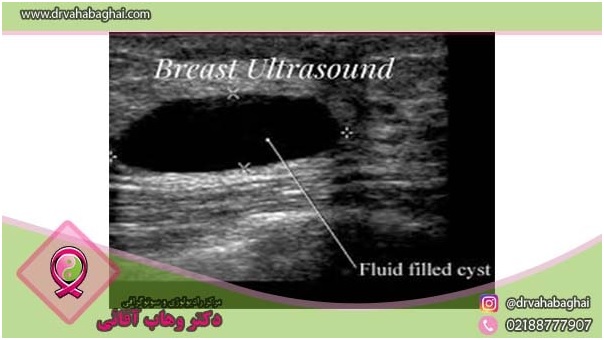 فیبروکیستیک در سونوگرافی
