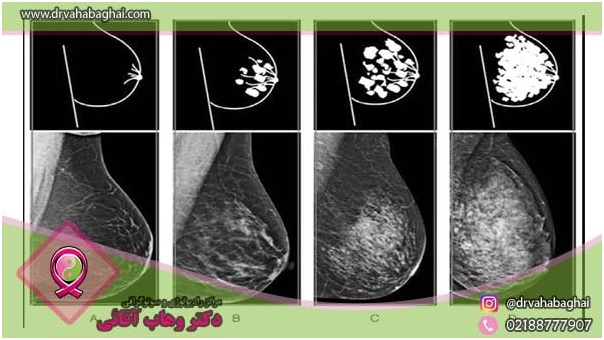 انواع فیبروکیستیک