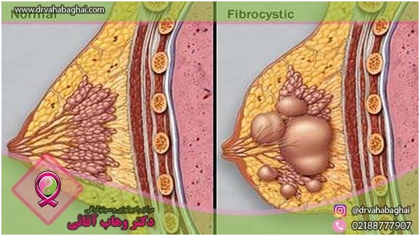 فیبروکیستیک بدخیم