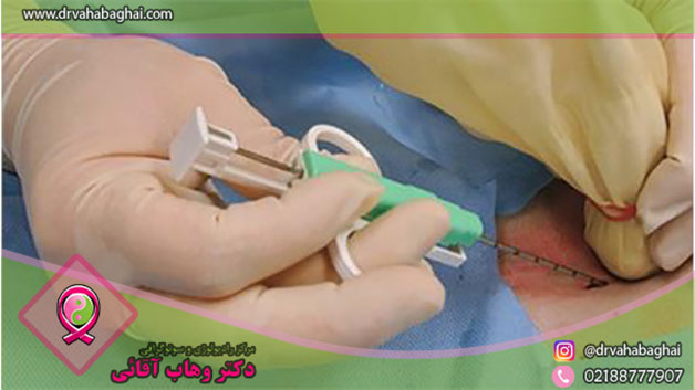 بیوپسی کلسیفیکاسیون پستان