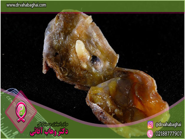 کیست در موئید چه زمانی ایجاد می شود