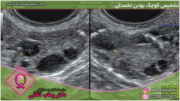 کوچک بودن تخمدان و بارداری