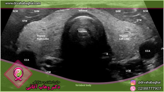ندول سرد تیروئید چیست