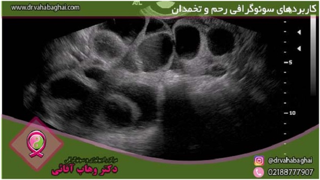 سونوگرافی رحم و تخمدان چیست