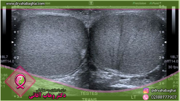 تفسیر سونوگرافی داپلر بیضه