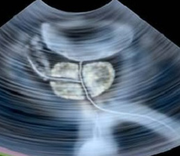 هزینه سونوگرافی پروستات