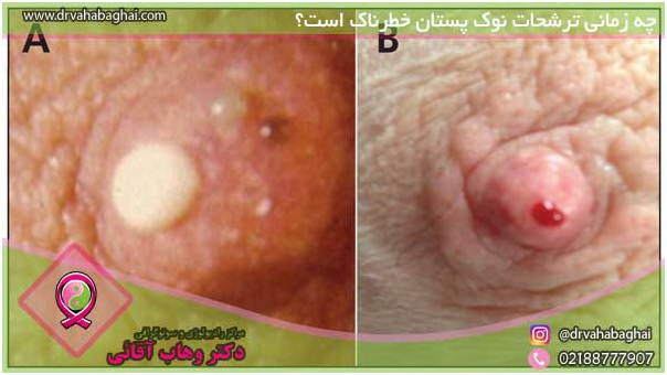 ترشح خطرناک پستان
