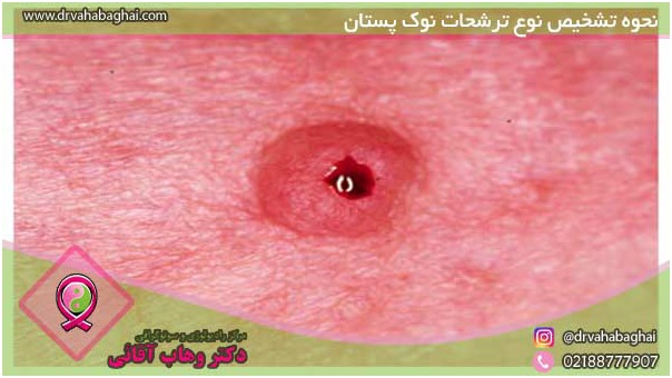 علت ترشح از نوک پستان زنان