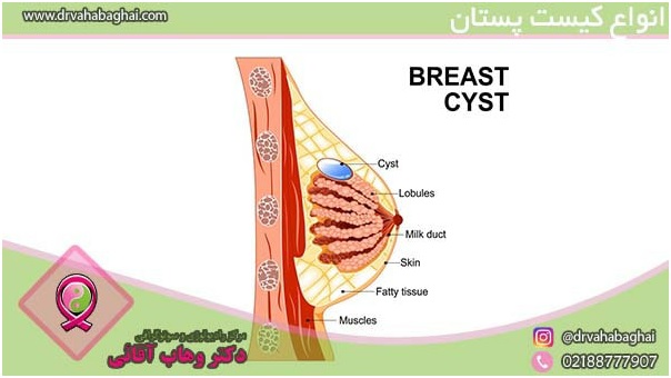 انواع کیست پستان