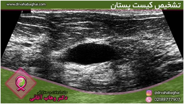 کیست پستان چیست