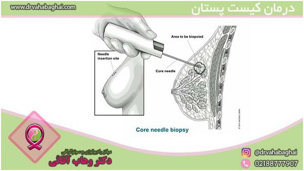 درمان کیست پستان