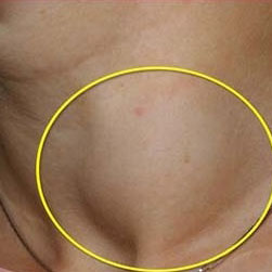 سرطان تیروئید خوش خیم