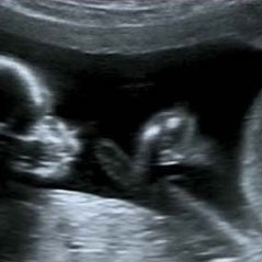سونوگرافی تعیین جنسیت