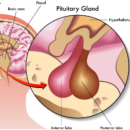 تومور غده هیپوفیز