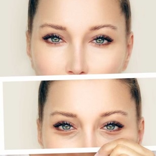 جراحی بلفاروپلاستی