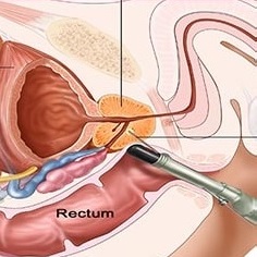 هزینه سونوگرافی رکتال