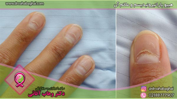 پاراتیروئید