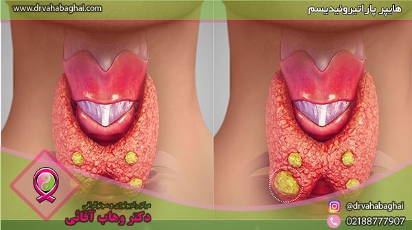 پاراتیروئید