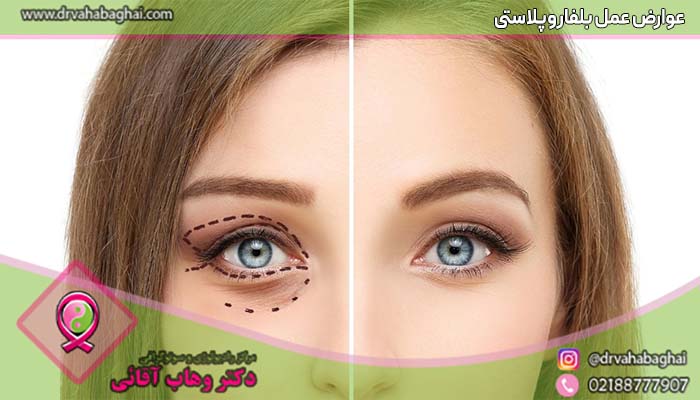 عوارض عمل بلفاروپلاستی