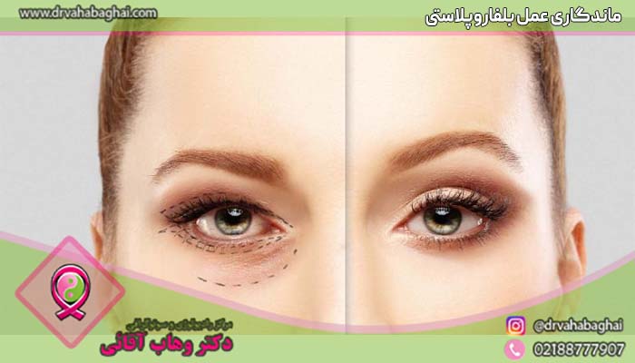 ماندگاری عمل بلفاروپلاستی