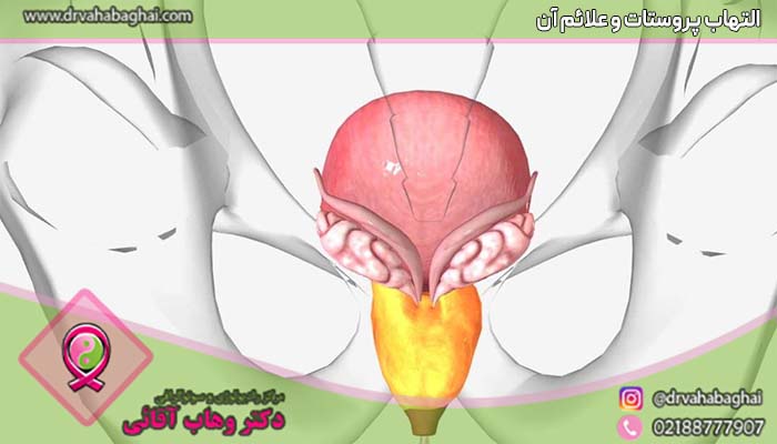 التهاب پروستات