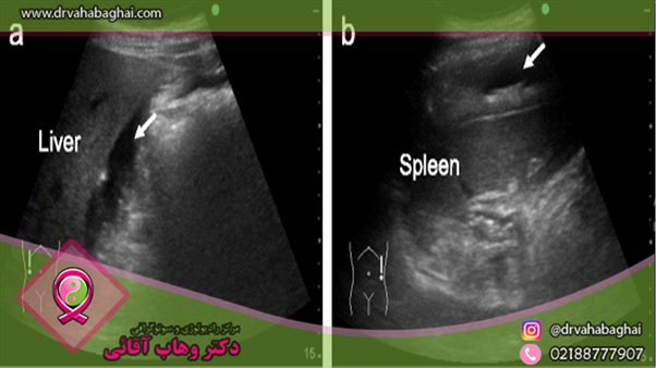 بررسی اعضای بدن با سونوگرافی شکمی