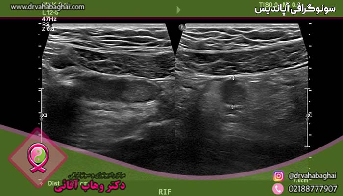 سونوگرافی آپاندیس