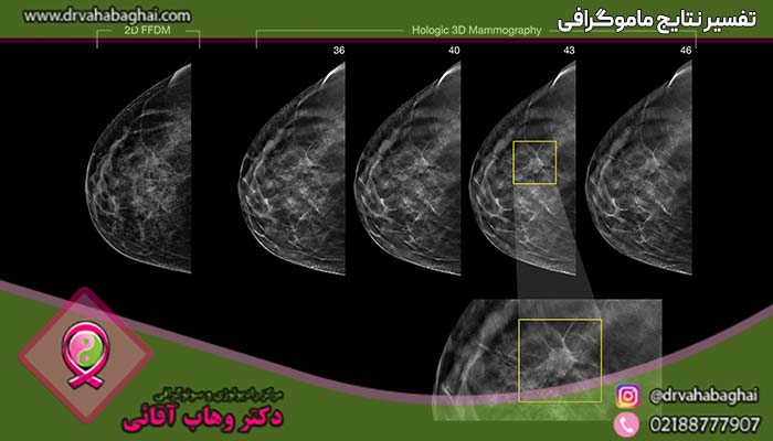 تفاسیر ماموگرافی