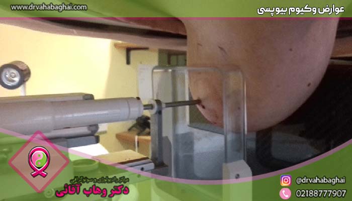 عوارض انجام وکیوم بیوپسی