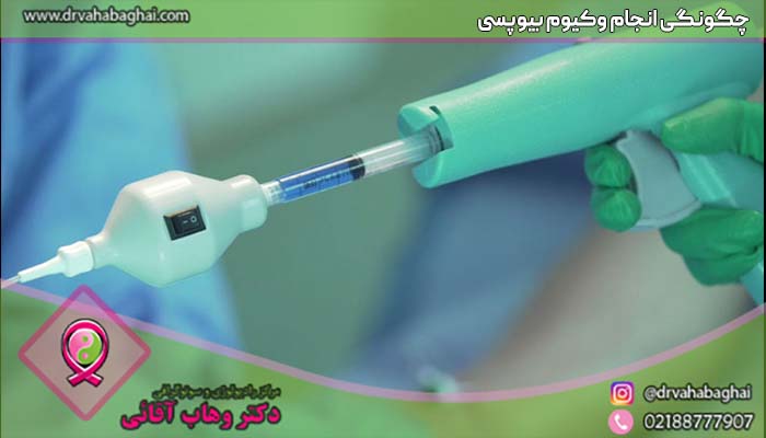 چگونگی انجام وکیوم بیوپسی