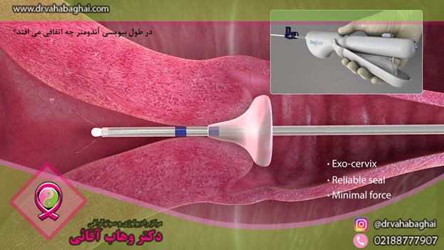 بیوپسی اندمتر