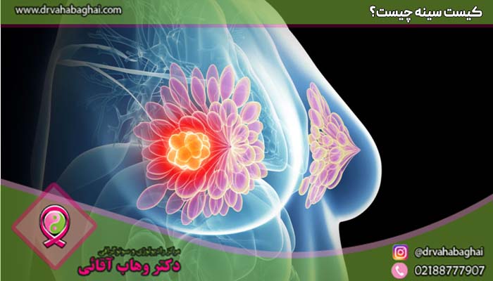کیست سینه چیست