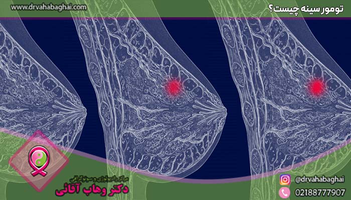 تومور سینه چیست