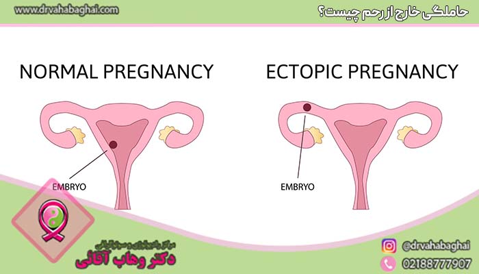 حاملگی خارج از رحم چیست