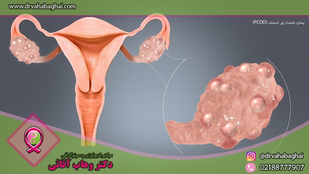تخمدان پلی کیستیک