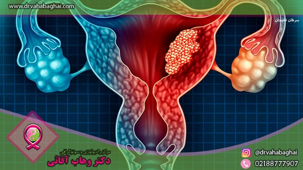 سرطان تخمدان