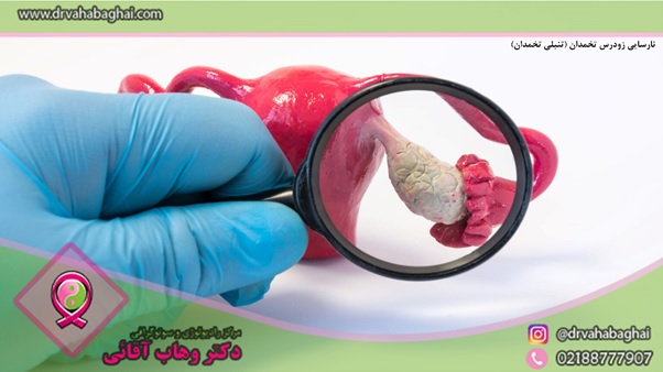 نارسایی زود رس تخمدان