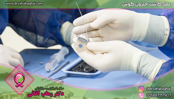 عمل کاشت حلزون گوش