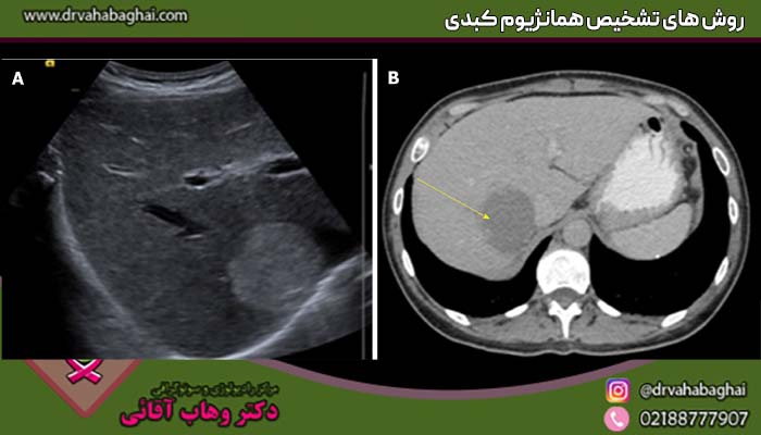 روش های تشخیص همانژیوم کبدی