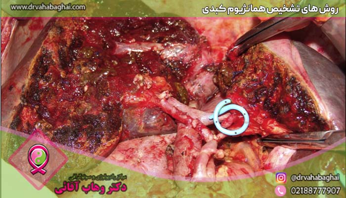 روش های درمان همانژیوم کبدی
